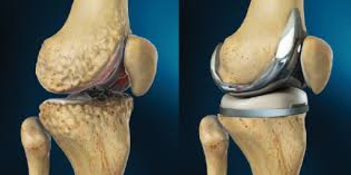 Regional Insights in the Cementless Total Knee Arthroplasty Market