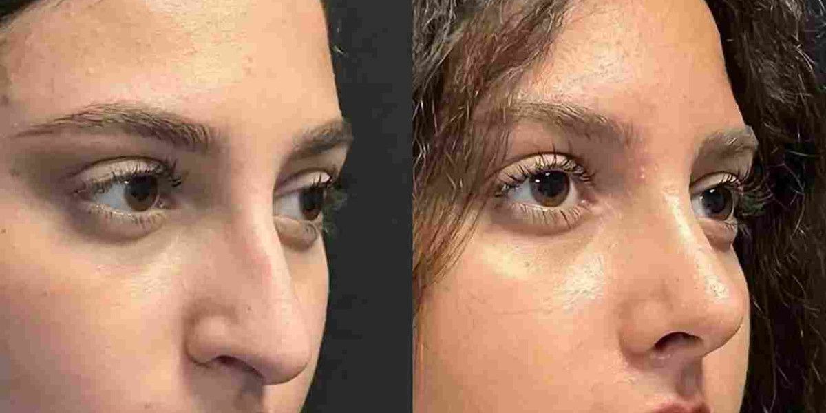 Best Rhinoplasty Surgeon in Dubai for Complex Nasal Reshaping