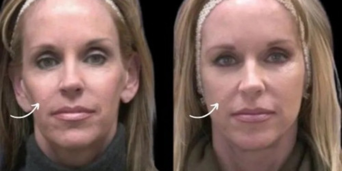 Sculptra Fillers in Dubai for Aesthetic Balance Science