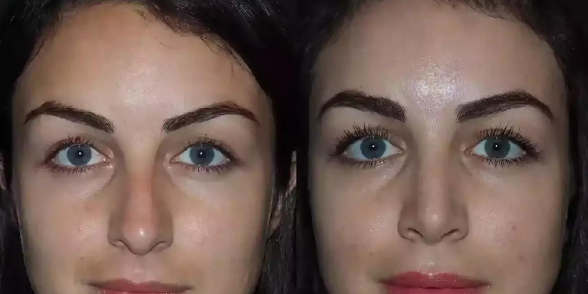 How the Best Septoplasty Surgeon in Dubai Enhances Health